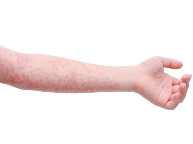 Measles Measles